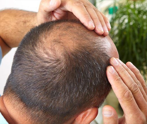 best hair transplant clinic in delhi